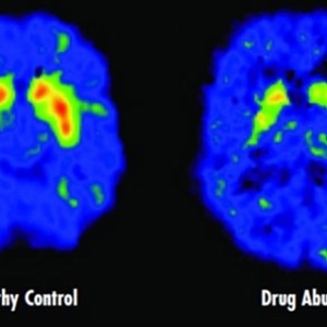 Zone rouge (dopamine) - Elle disparaît chez un consommateur de drogue.